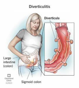 10352 diverticulitis