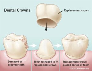 10923 dental crowns