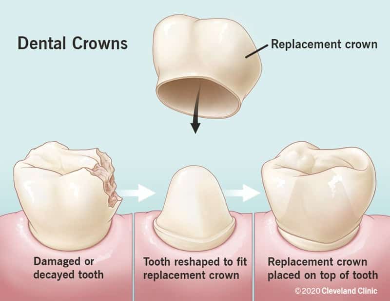 10923 dental crowns