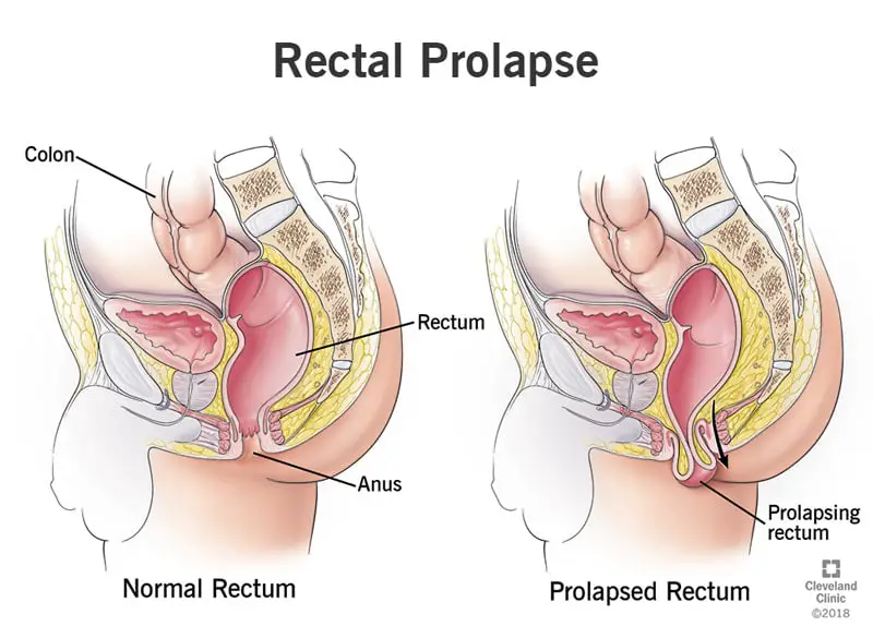 14615 rectal prolapse