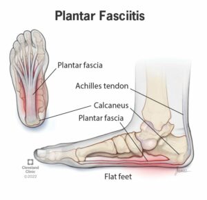 14709 plantar fasciitis