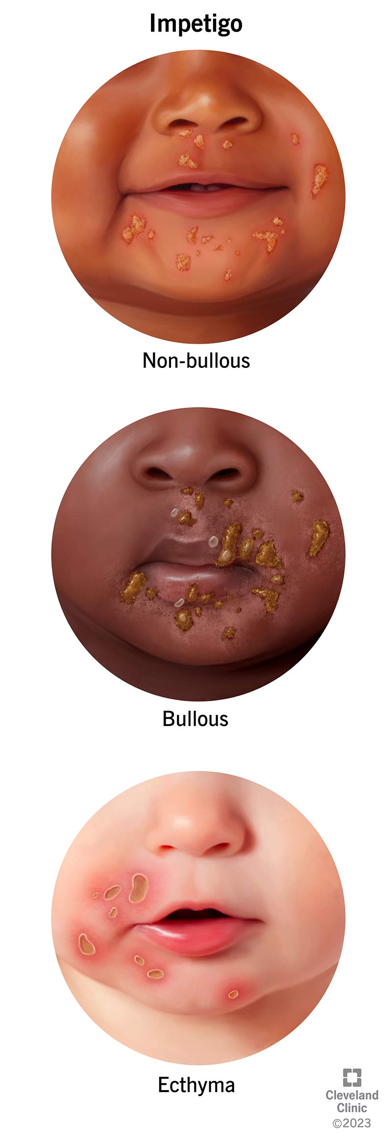 Impetiigo kolm staadiumi: mitte-bulloosne, bulloosne ja ektüüm.