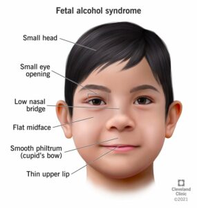 15677 fetal alcohol syndrome