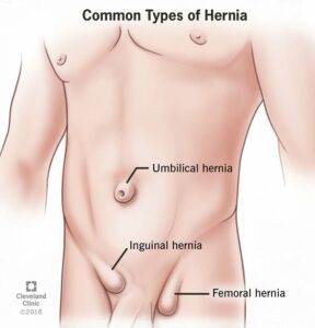 15757 hernia