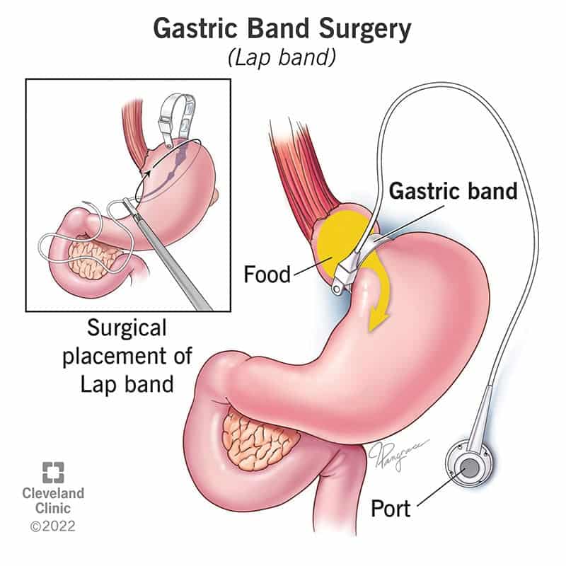 17163 gastric band surgery