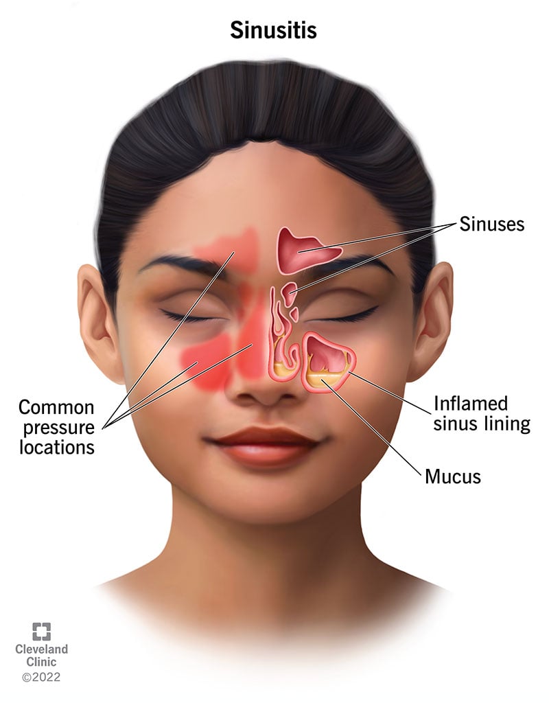 Illustratsioon, millel on põletikulised, vedelikuga täidetud ninakõrvalurged.  Tavalised valu- või survepunktid on teie otsaesises, põskedes ja ninas.