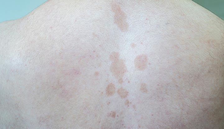 Tinea versicolor inimese ülaselja keskel.