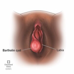 17737 bartholin cyst