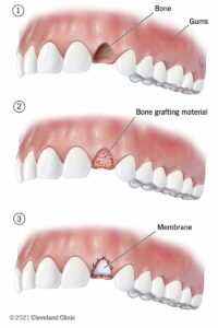 21727 Dental Bone Graph Illustration