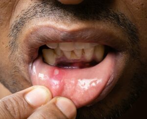 21766 mouth ulcer