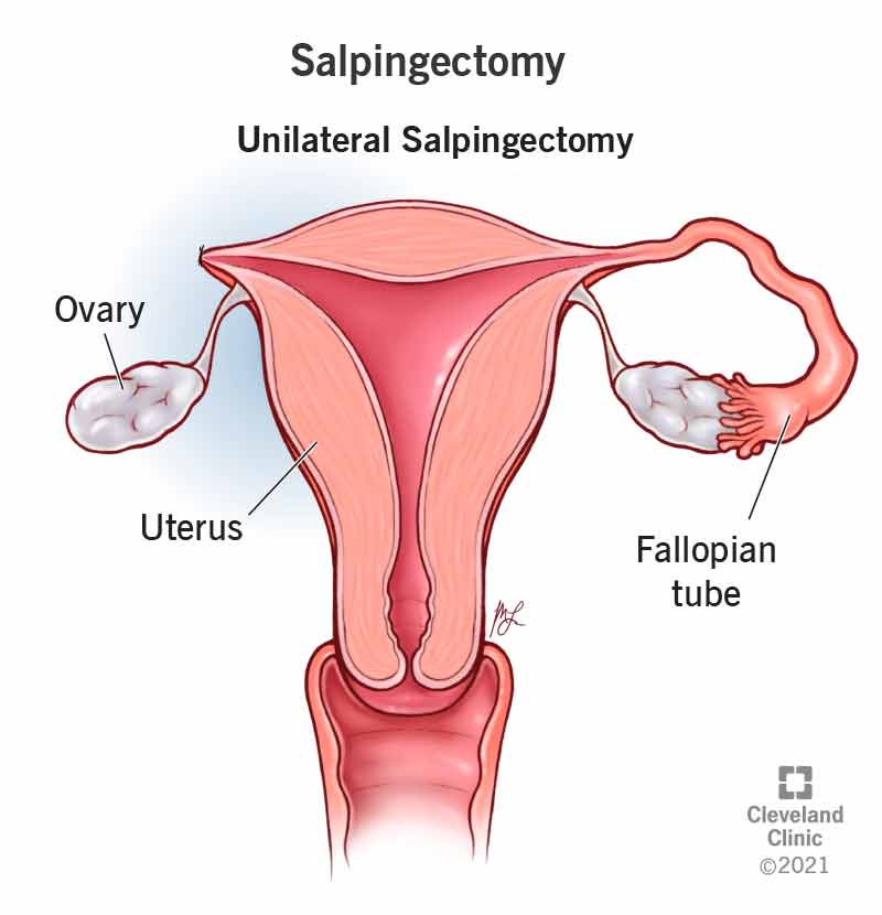 21879 salpingectomy