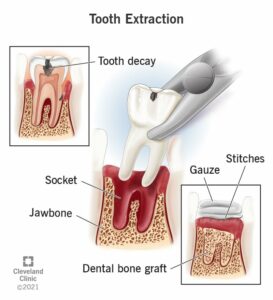 22120 tooth extraction