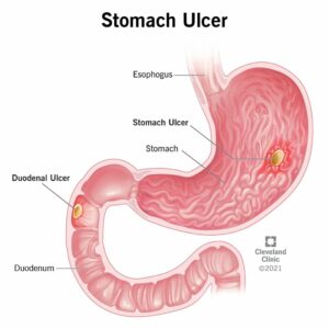 22314 stomach ulcer.ashx