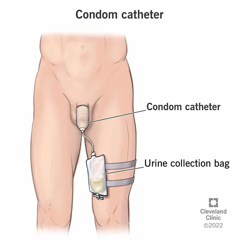 22475 condom catheter