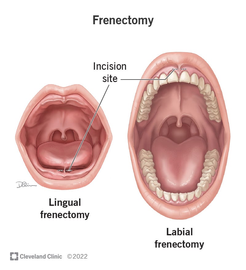 22714 frenectomy