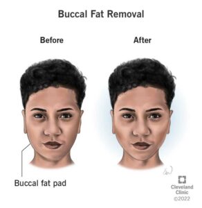 23396 buccal fat removal