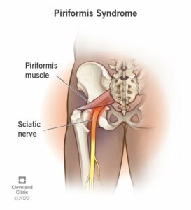 23495 piriformis syndrome