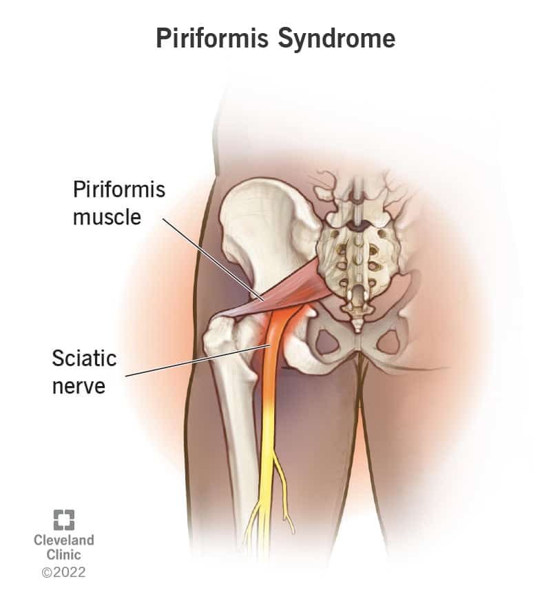 23495 piriformis syndrome