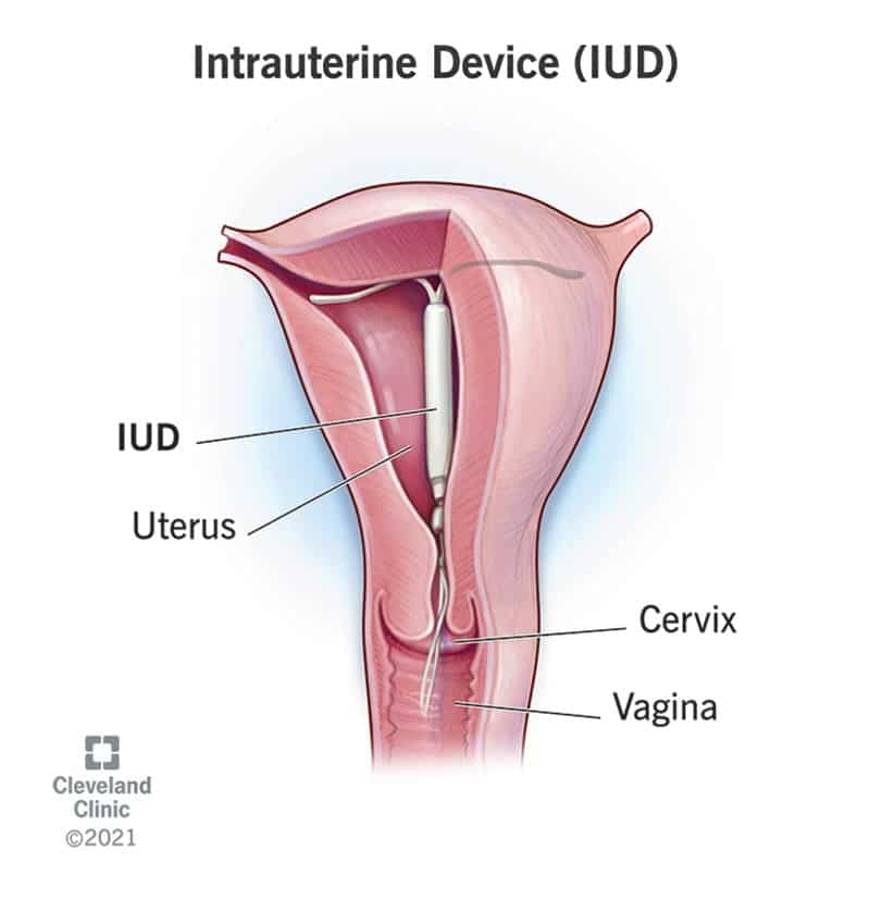 24441 intrauterine device iud