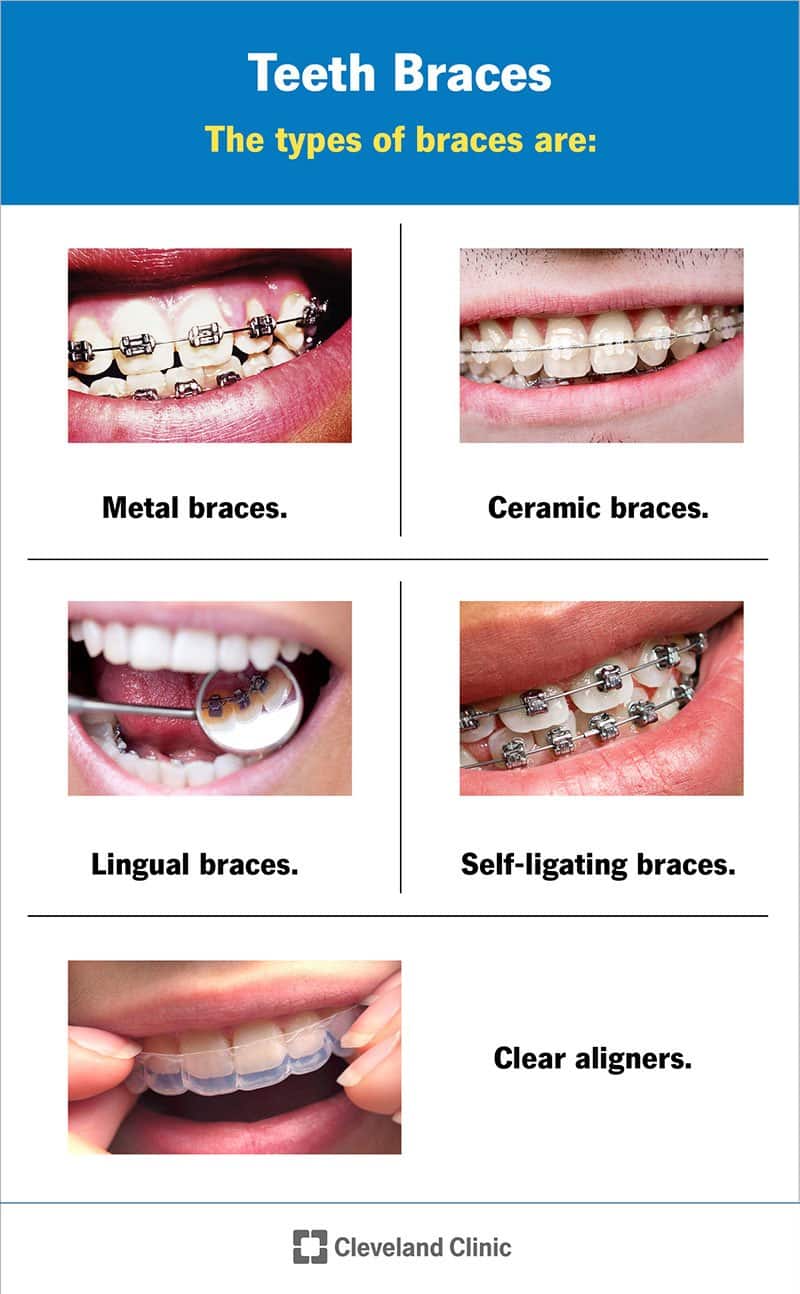 Erinevat tüüpi breketid on metallist, keraamilised, linguaalsed, iseligeeruvad ja läbipaistvad breketid.