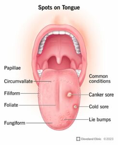 24632 spots on tongue