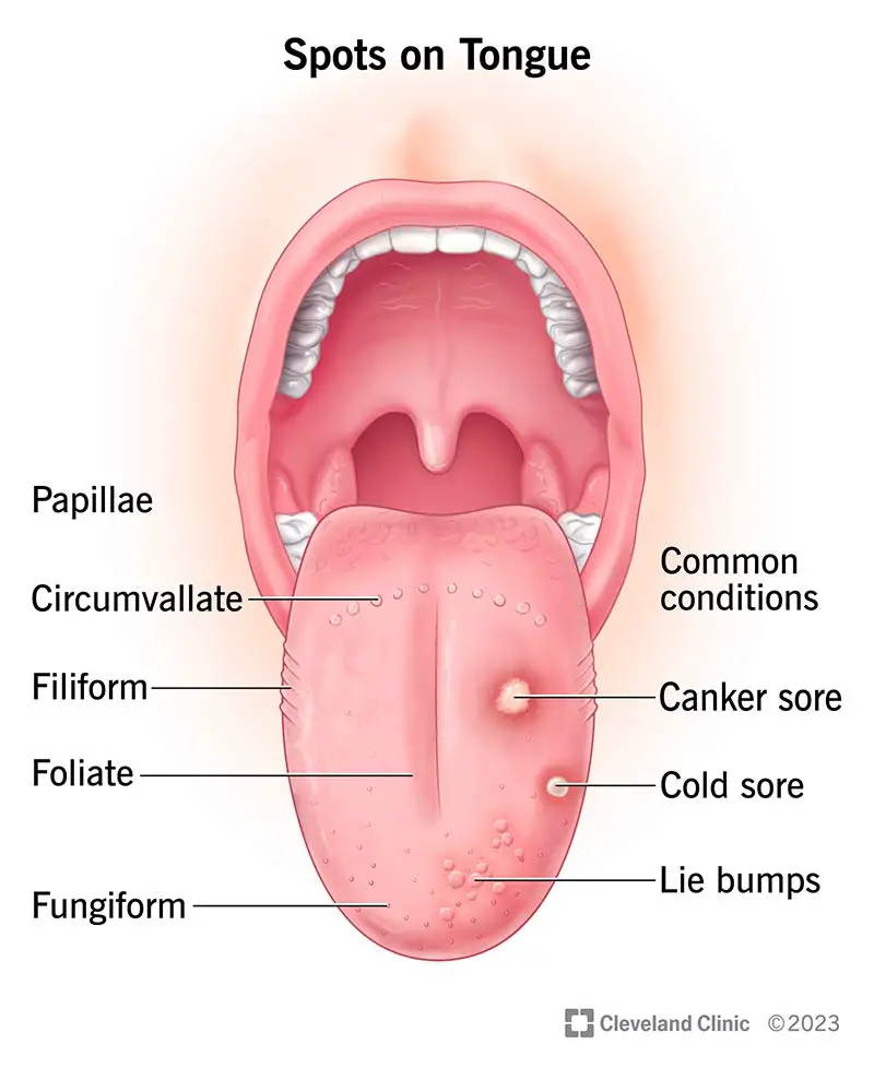 24632 spots on tongue