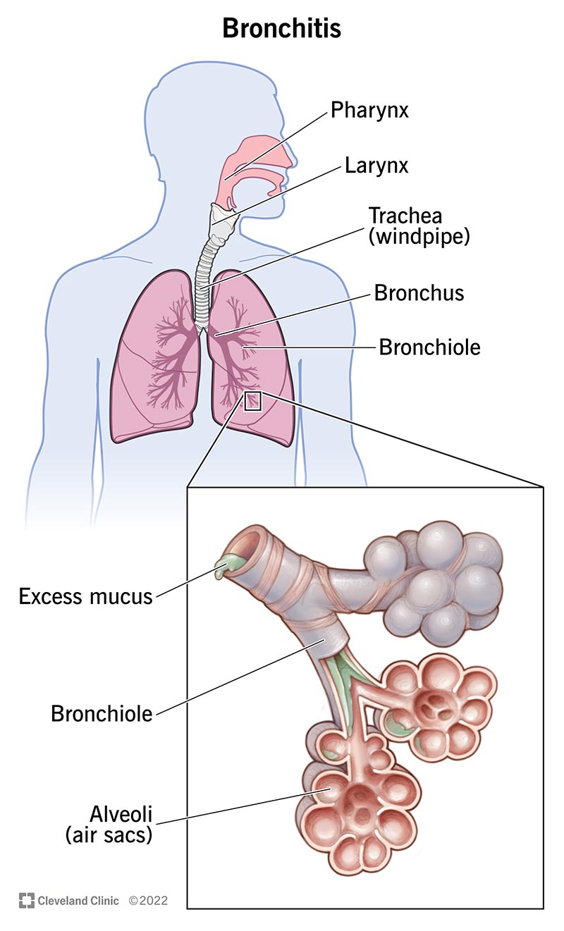 Pilt, mis näitab teie kopsude anatoomiat.  Kui teil on bronhiit, on teie bronhides liigne lima.