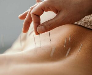 4767 acupuncture