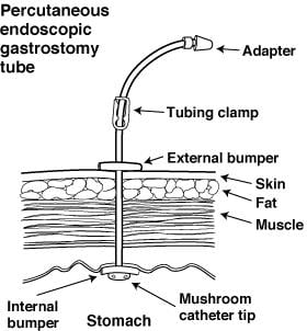 4911 peg tube