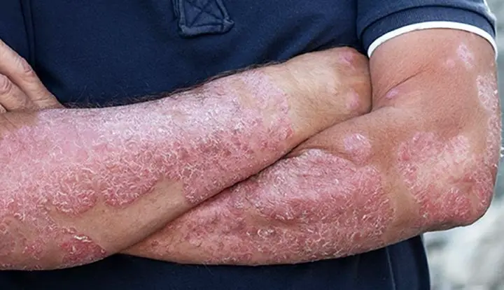 6866 psoriasis