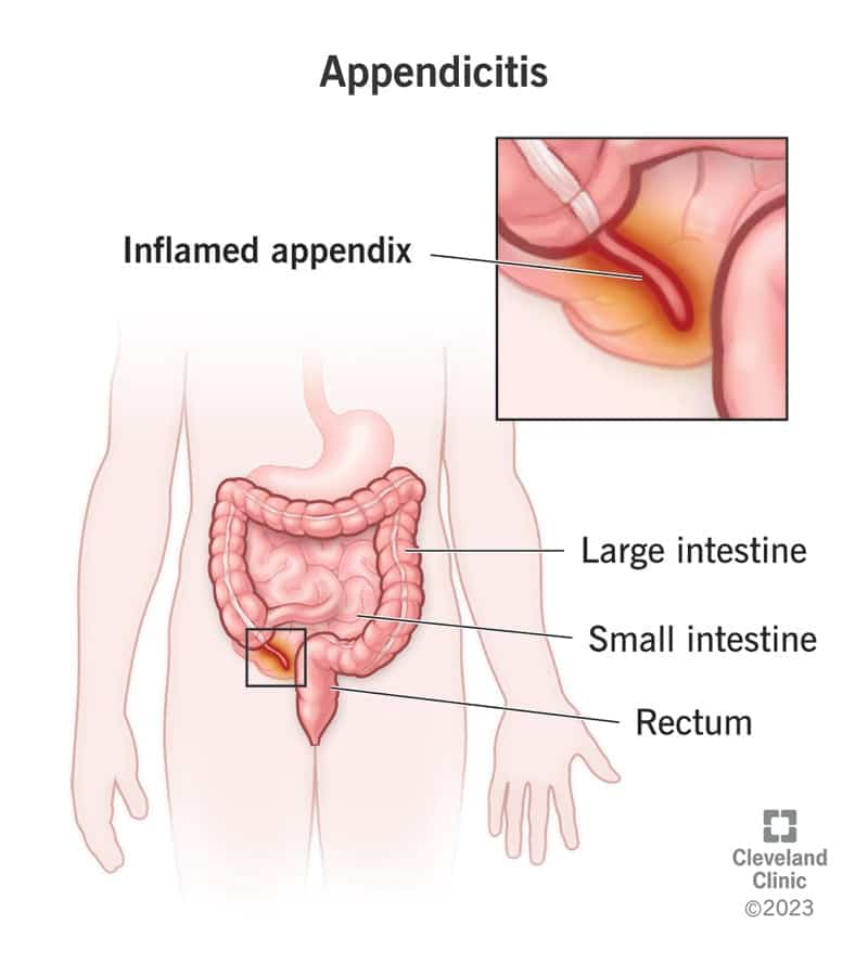 8095 appendicitis