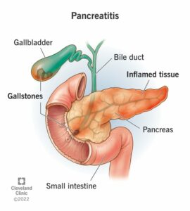 8103 pancreatitis illustration