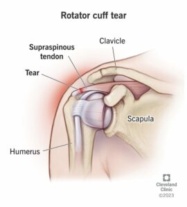 8291 rotator cuff tear