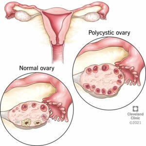 8316 polycystic ovary syndrome pcos