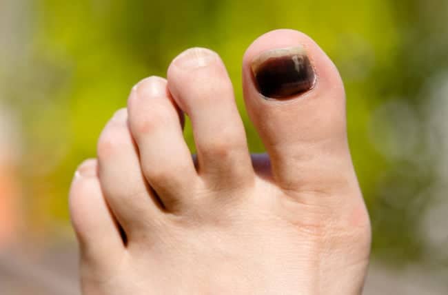 blackToenails 497274351 770x533 1