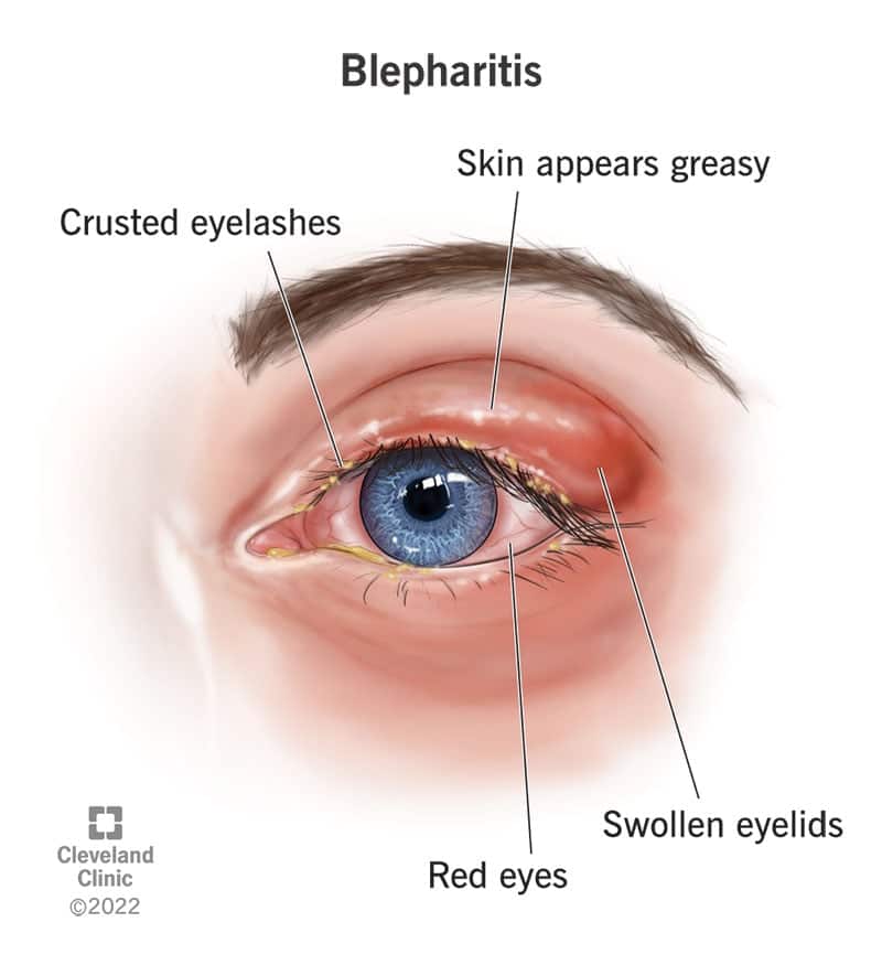 10032 blepharitis