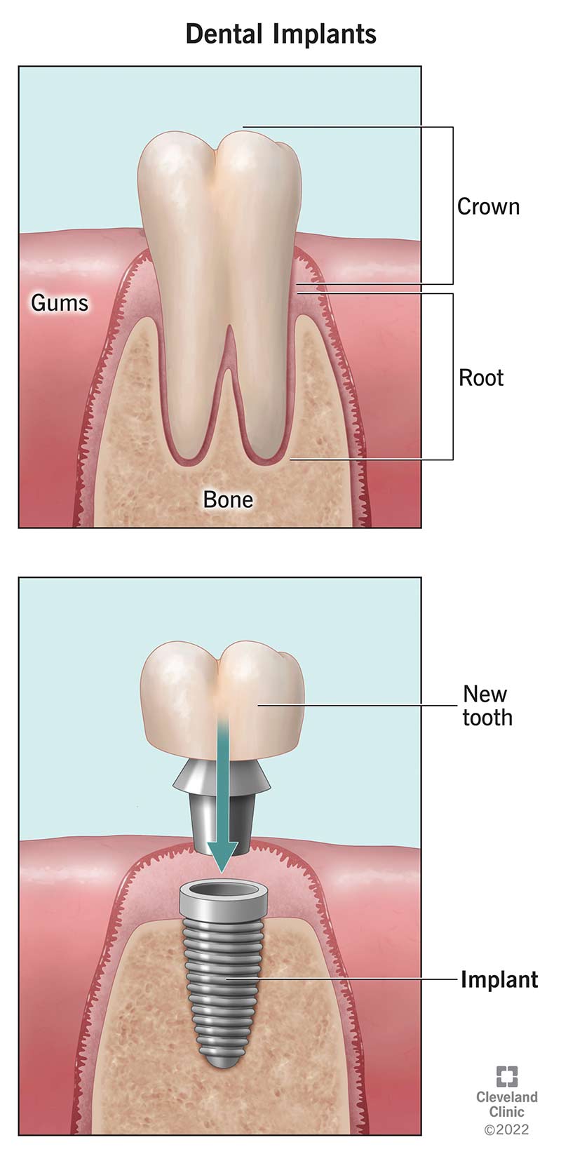 Looduslik hammas vs hambaimplantaat lõualuus.
