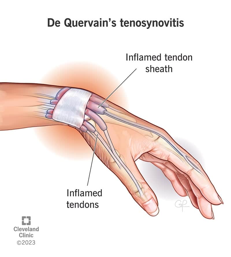 10915 dequervains tendosynovitis