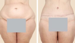 11009 liposuction