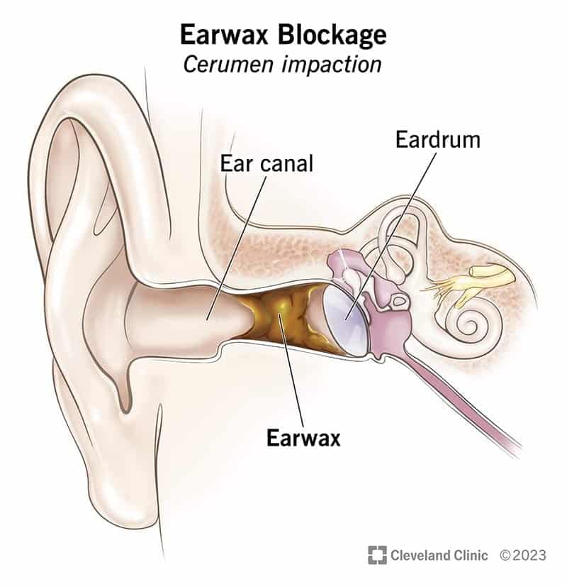 14428 earwax blockage