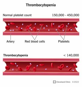 14430 thrombocytopenia