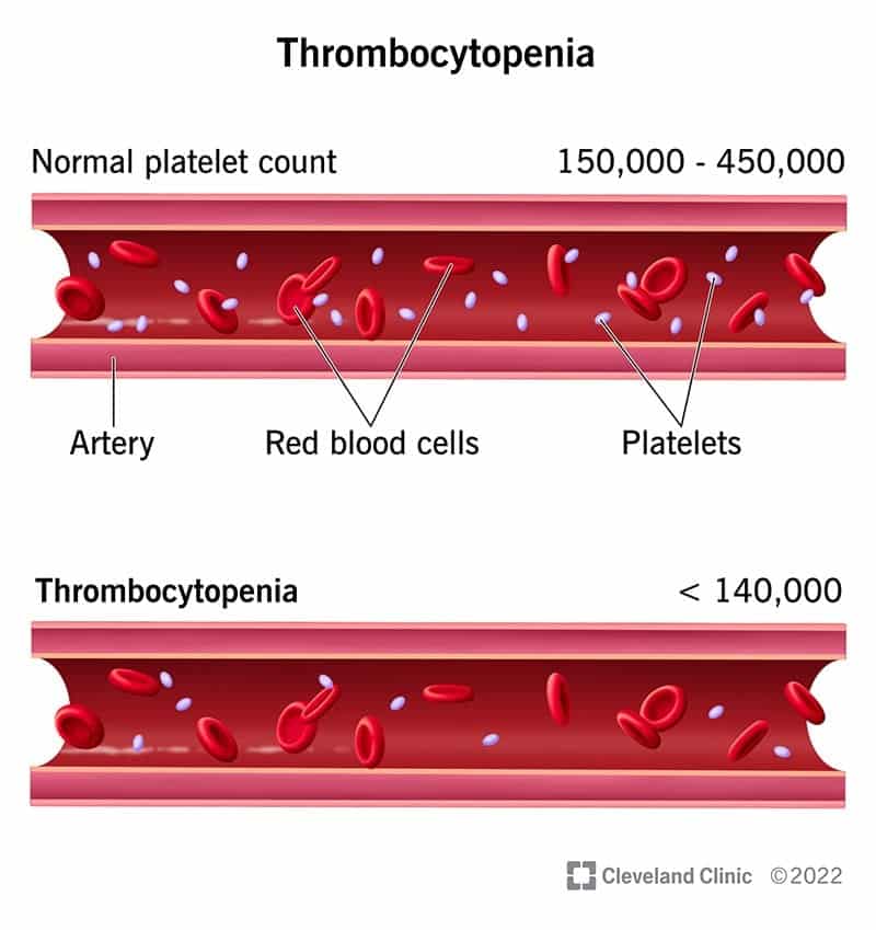 14430 thrombocytopenia