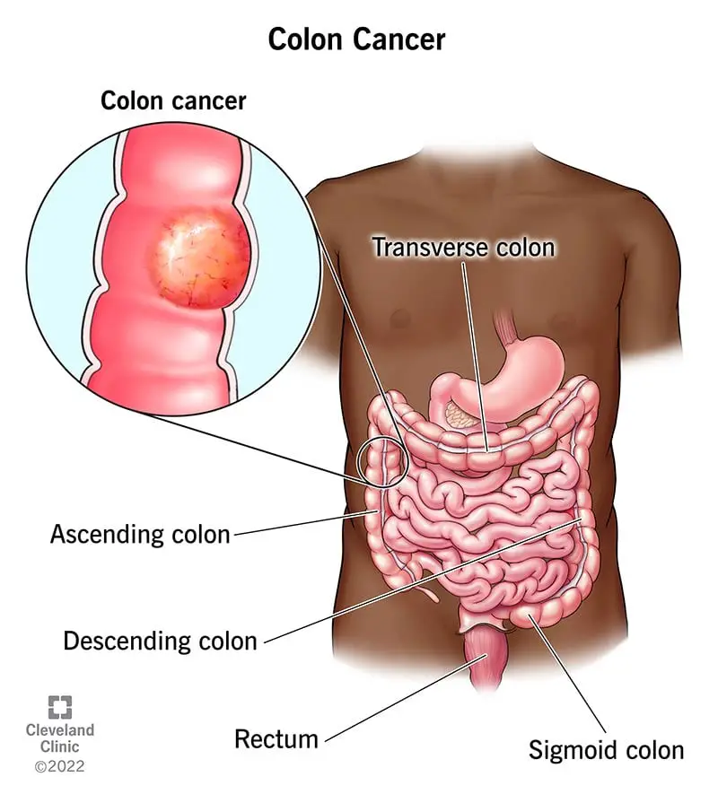 14501 colorectal cancer