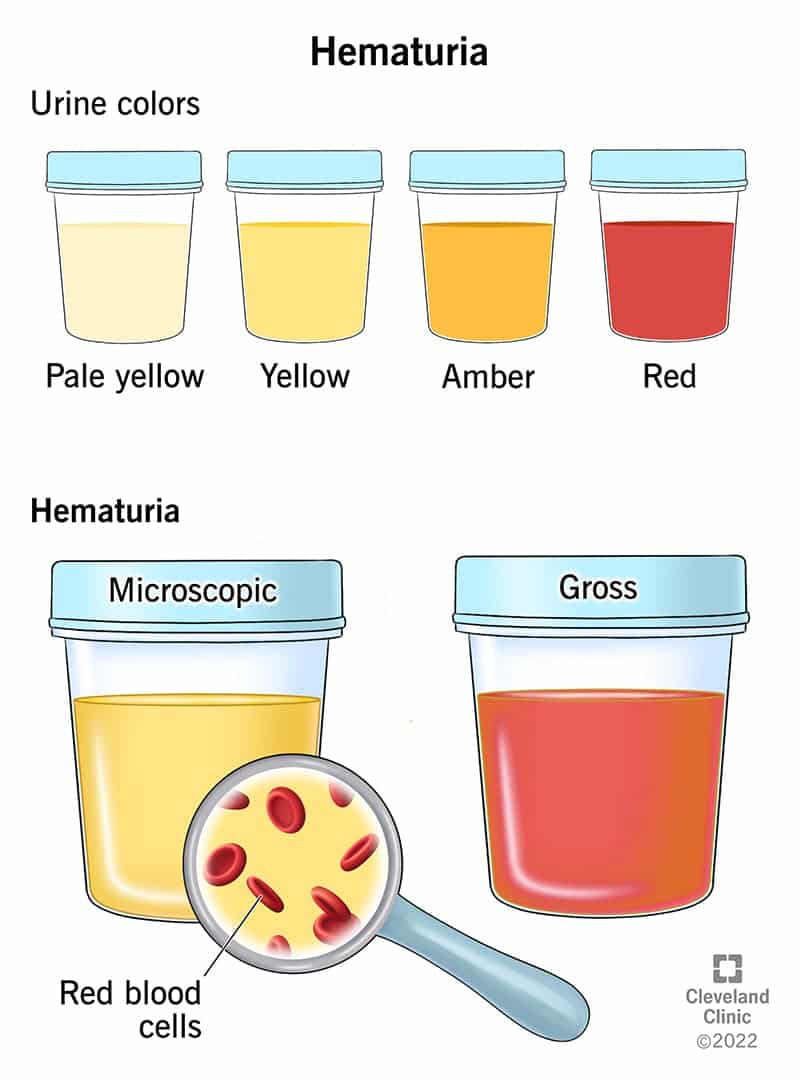 Hematuuria ehk veri uriinis võib olla jäme (veri on nähtav ilma mikroskoobita) või mikroskoobiga (nähtav ainult mikroskoobiga).