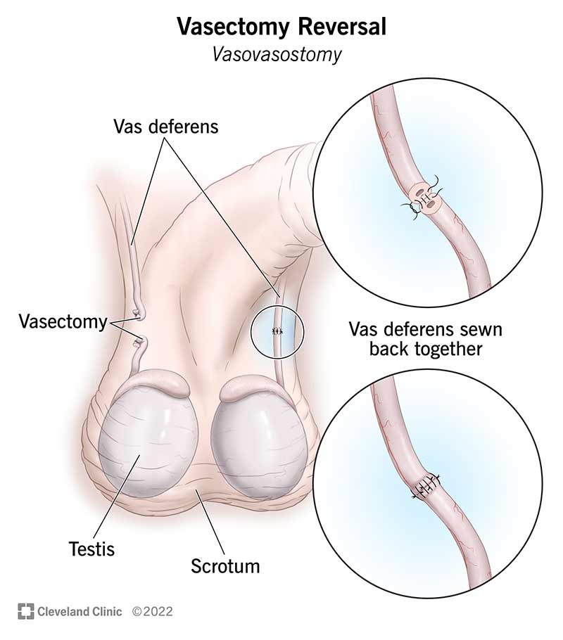 15459 vasectomy reversal