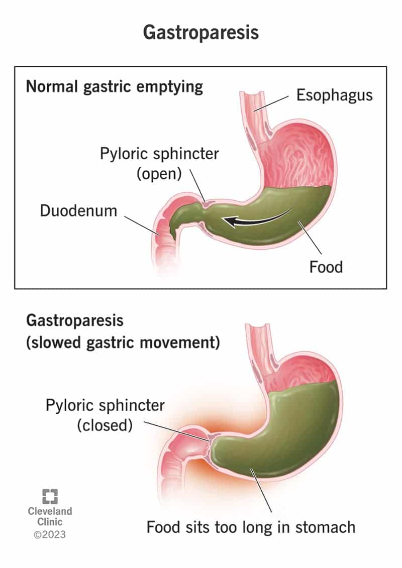 Gastropareesi korral ei liigu toit normaalselt läbi mao.