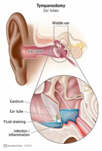 15609 tympanostomy