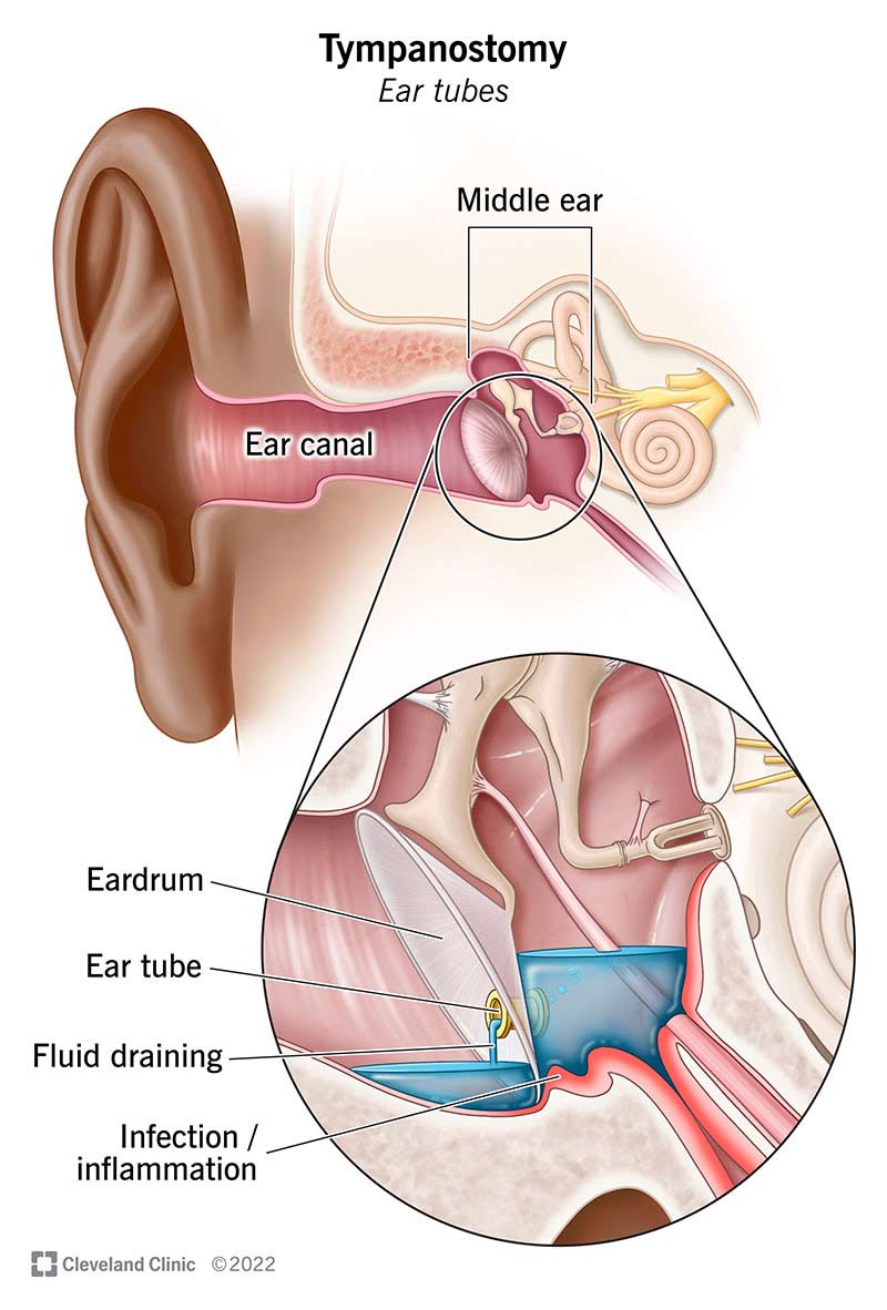 Tümpanostoomi (kõrva) toru, mis juhib vedelikku keskkõrvast.