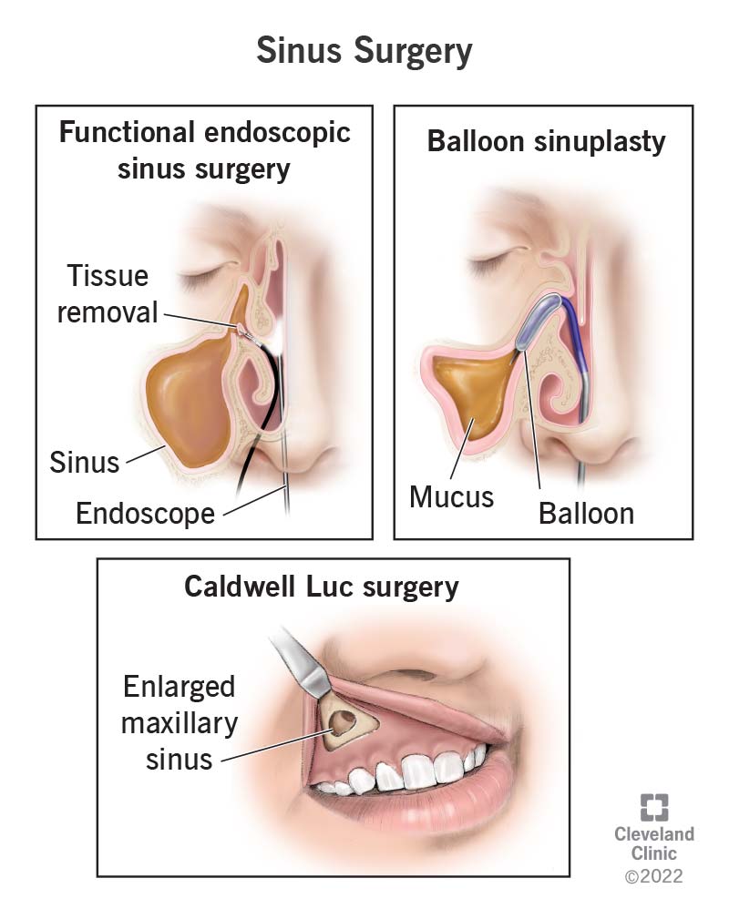 15854 sinus surgery