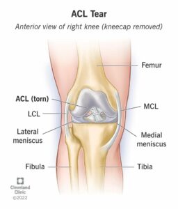 16576 acl tear